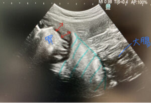 胃のエコー画像