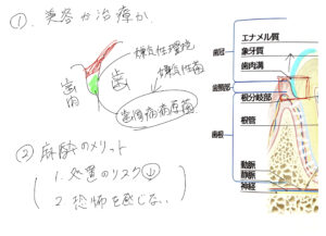 歯石とりの説明図