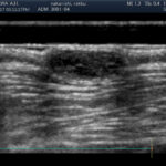 皮膚エコー写真