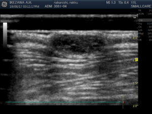 高周波皮膚エコー画像