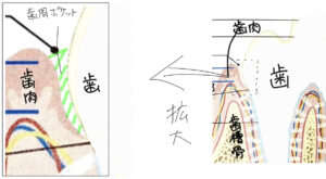歯周ポケットの位置の図解イラスト