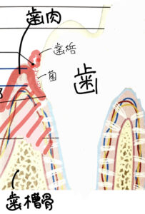 腫れた歯肉と溶けた歯槽骨の図解イラスト