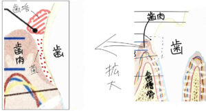 歯垢と歯周ポケットに菌が増えている様子の図解イラスト