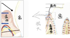 歯石除去によって歯肉が元に戻ったイラスト