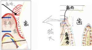 歯肉に炎症が起こっている様子の図解イラスト