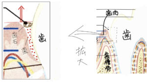 歯肉より上の（目につく）歯石だけなくなっている様子のイラスト