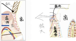 歯石で蓋をされた歯周ポケットに歯周病病原菌が増える様子