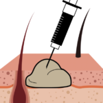腫瘍の検査をするイメージ図