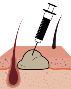 FNAの図解イラスト