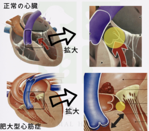 肥大型心筋症の心臓と正常な心臓の比較