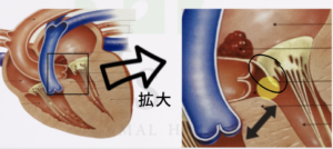 左室流出路閉塞とACE阻害薬を使用した時の図解イラスト