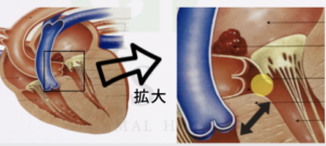 左室流出路閉塞の図解イラスト