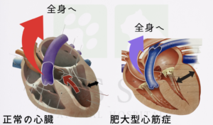 肥大型心筋症の心臓と正常な心臓の比較