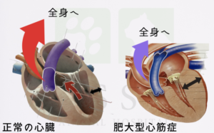肥大型心筋症の心臓と正常な心臓の比較