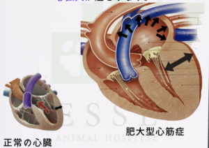 肥大型心筋症の心臓と正常な心臓の心拡大比較