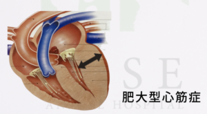 肥大型心筋症の心筋の厚みを表した様子