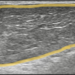 皮膚エコー検査画像