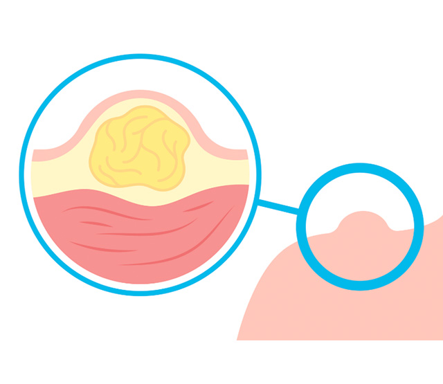 皮膚にできたしこりの良性・悪性の判別と治療方針